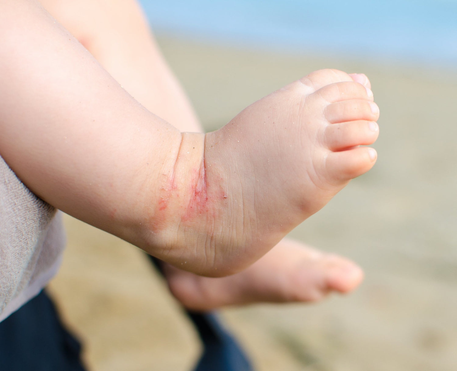 Eczéma, urticaire, psoriasis